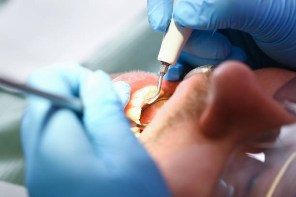 Best Chipped Tooth Repair Near Me  in Huntsville, MO